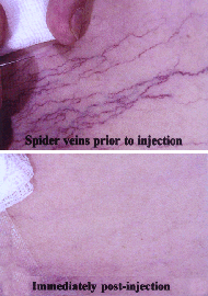 Thread veins before and after treatment